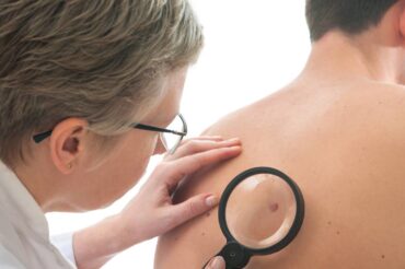 Cancers de la peau : les signes qui doivent alerter