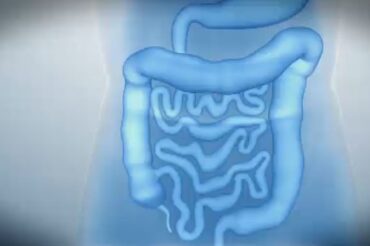 Montreal study finds colorectal cancer on the rise among younger Canadians