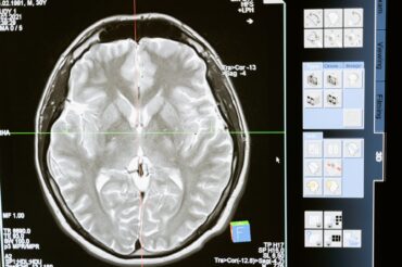 De faibles doses de rayonnement peuvent aider les patients atteints de la maladie d’Alzheimer?