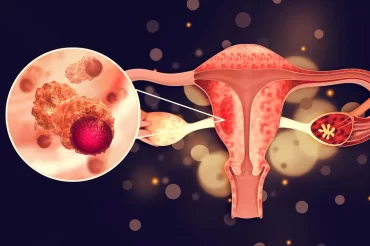 Endometriosis may be linked to ovarian cancer – but it’s not all bad news