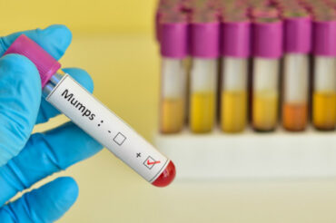 Manitoba mumps outbreak 100 times higher than normal