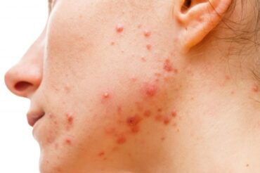 New acne diagnoses linked to increased depression risk