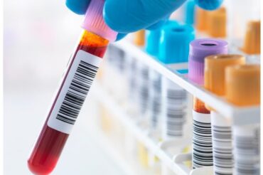 A big step toward a blood test for Alzheimer’s