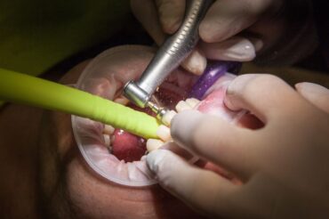 Bientôt un nouveau traitement capable de régénérer naturellement les dents cariées ?
