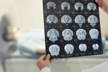 Être bilingue réduit-il l’impact d’Alzheimer sur le cerveau ?
