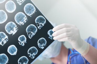 Stroke may double risk for dementia, study says