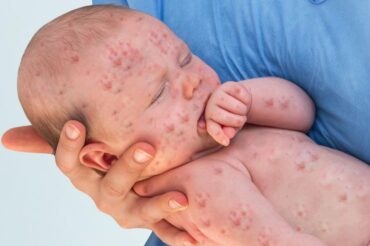 Washington measles outbreak shows anti-vaxxers are literally making us sick