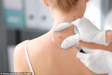 Skin cancer: having a close relative with the disease ‘raises someone’s chance of getting melanoma by 74 per cent’