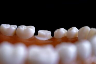 People with gum disease more likely to have high blood pressure
