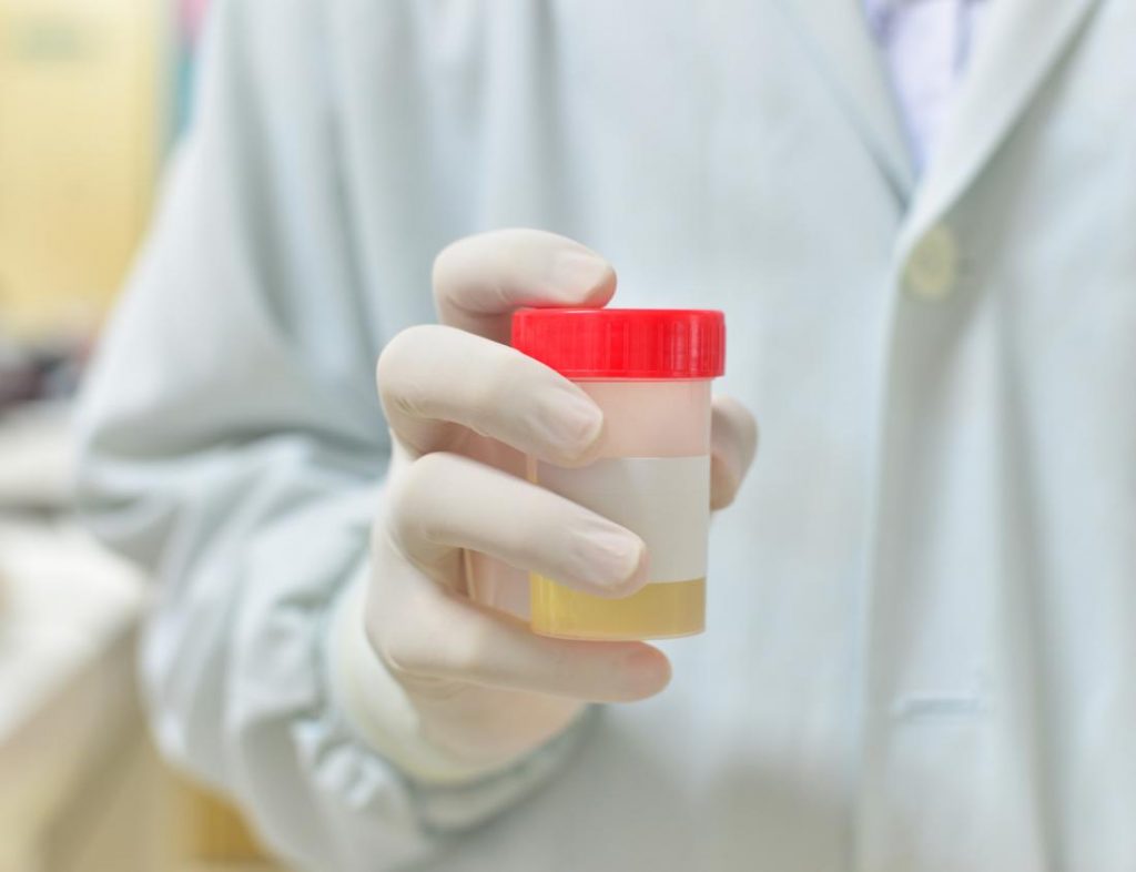 Prostate Cancer Home Urine Test Could Revolutionize