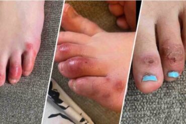 ‘COVID toes’: mysterious skin condition could be linked to coronavirus, derms say