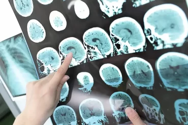 Un traitement expérimental contre Alzheimer ralentit le déclin cognitif